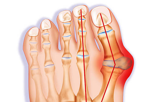 Bunion treatment