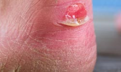 Friction blisters treatment
