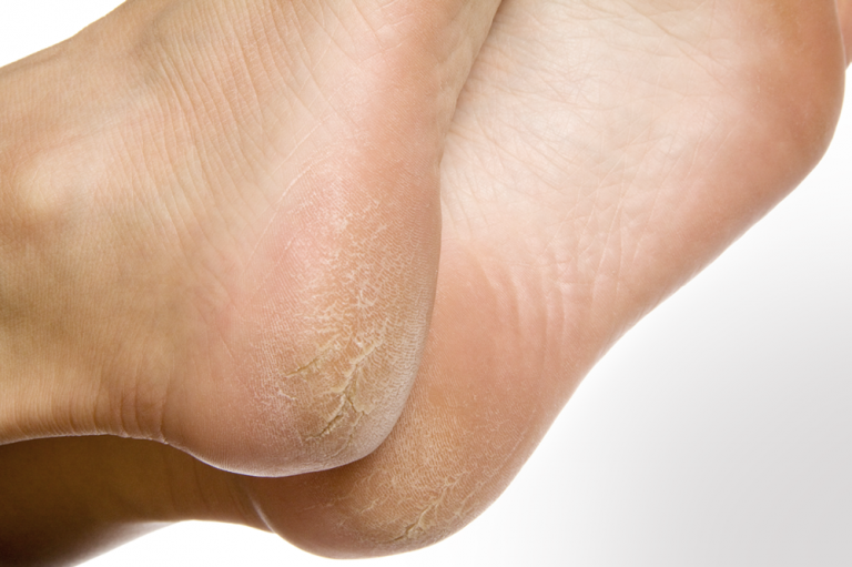 Heel fissures treatment