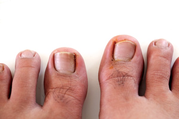 Ingrown toenails treatment